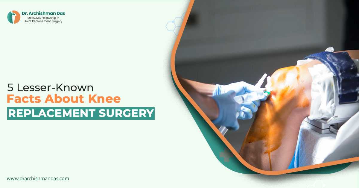 5 Lesser-Known Facts about Knee Replacement Surgery